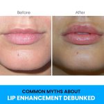 COMMON MYTHS ABOUT LIP ENHANCEMENT DEBUNKED