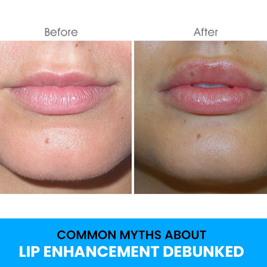 Lip Enhancement At Sculpt Sublime Clinic, the best cosmetic surgery and plastic surgery clinic in Mumbai