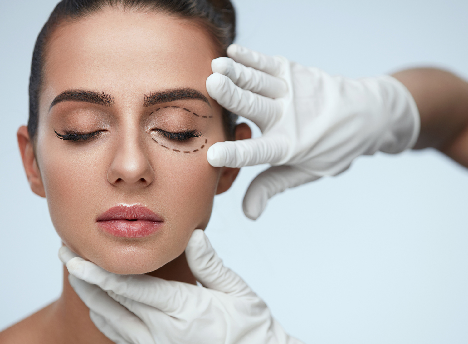 Woman with markings on her eye before undergoing Blepharoplasty (Eyelid surgery)