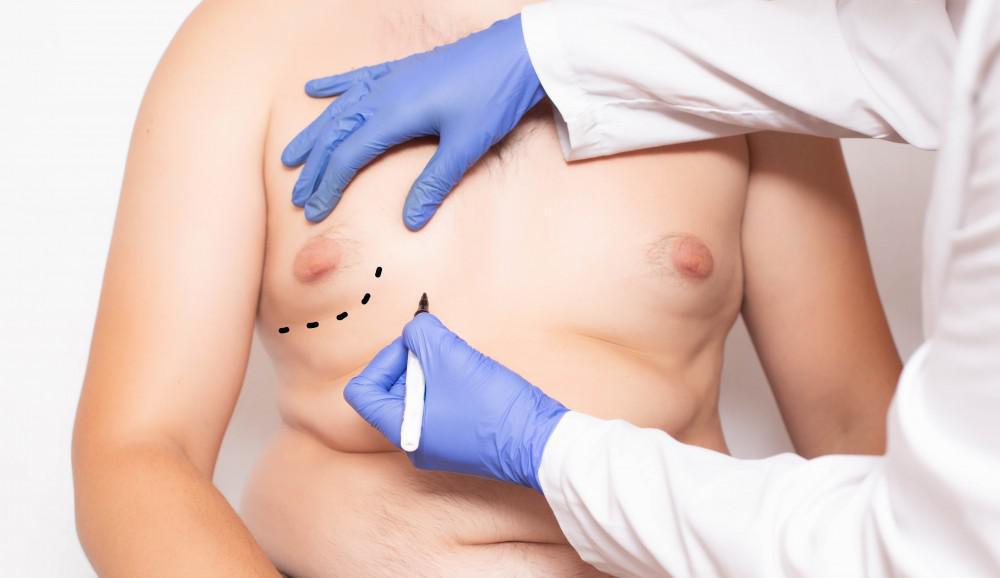 Doctor making markings on a male patient before he undergoes surgery for Gynecomastia also known as man boobs