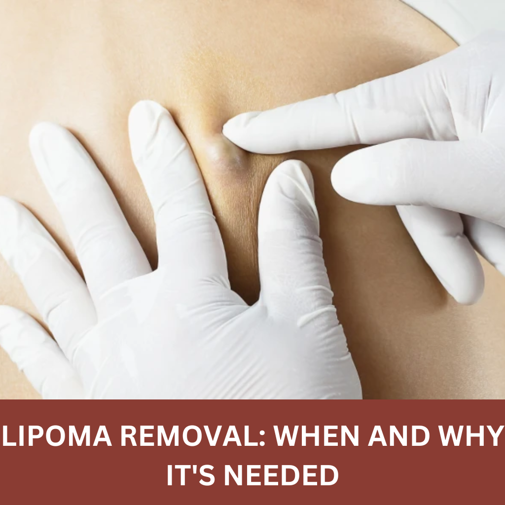 Why Surgery is Needed For Lipoma Removal