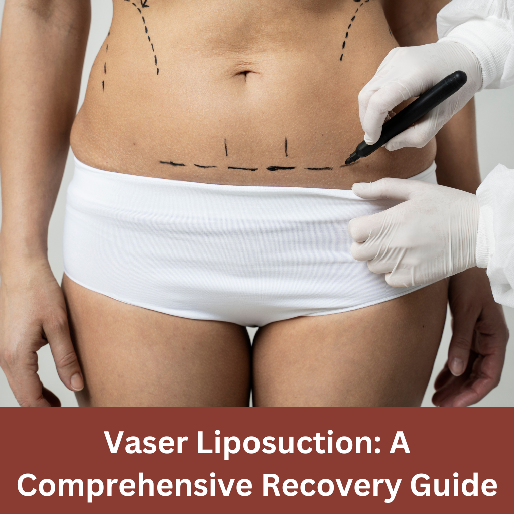 Vaser Liposuction Guide