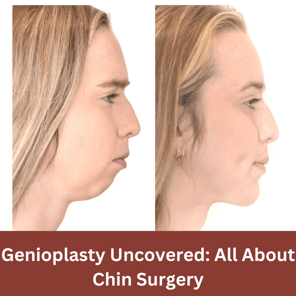 A Guide On Genioplasty Surgery