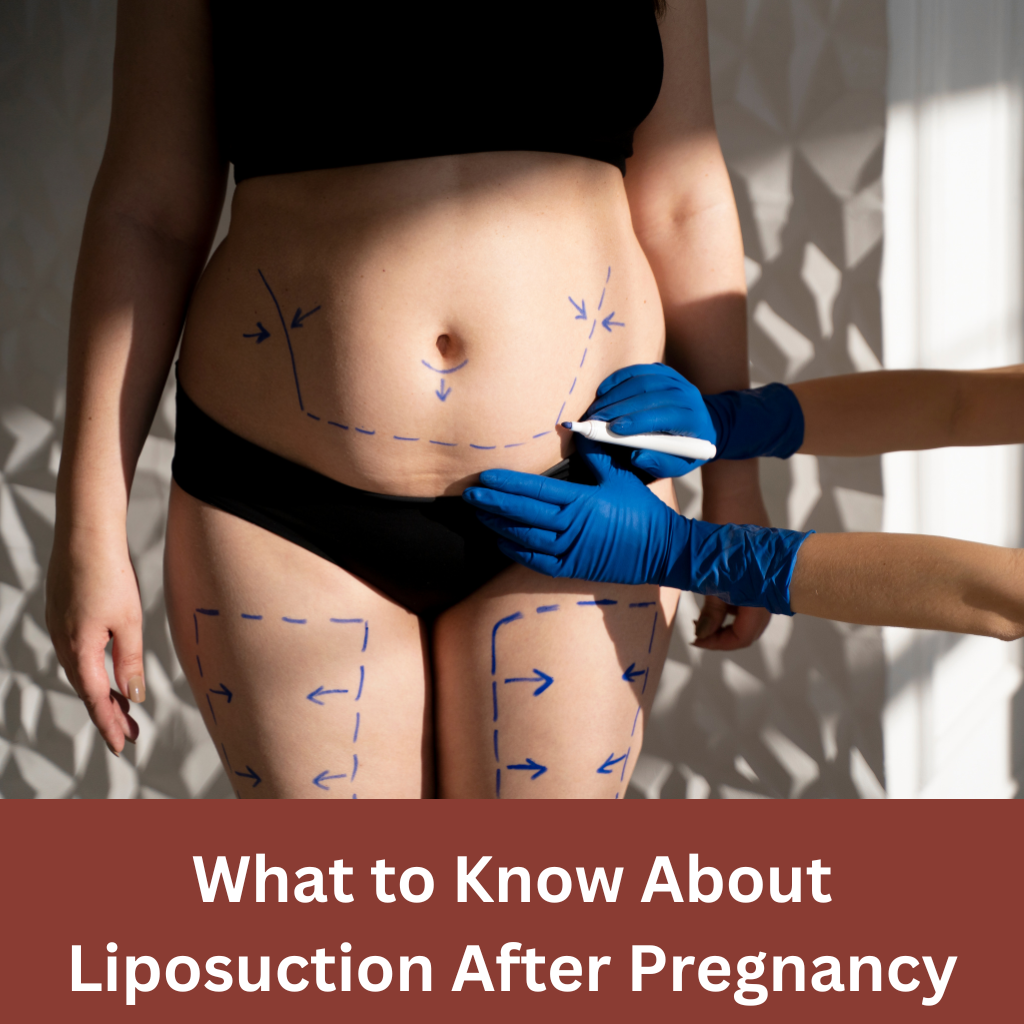 Liposuction After Pregnancy