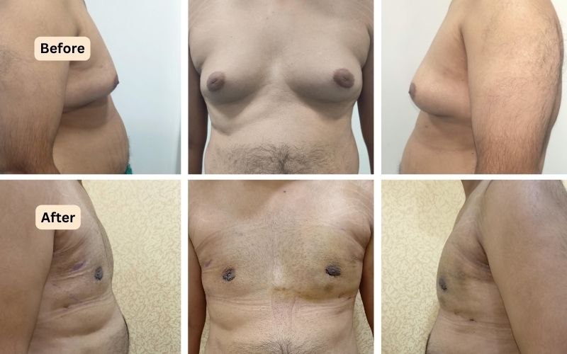 before and after results of gynecomastia surgery