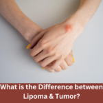 What is the Difference between Lipoma & Tumor?