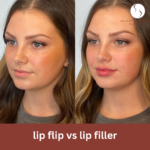 lip flip vs lip filler